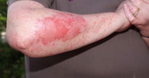 How To Manage Dermatitis, Psoriasis, And Eczema, eczema,atopic dermatitis,eczema treatment,psoriasis,how to treat eczema,seborrheic dermatitis,dermatitis,what is eczema,eczema on face,how to cure eczema,scalp psoriasis,eczema triggers,eczema cure,how to manage seborrheic dermatitis,how to manage seborrheic dermatitis on scalp,eczema skin care,eczema symptoms,atopic dermatitis - eczema,atopic dermatitis vs eczema,what causes eczema,psoriasis diet,how to get rid of eczema,what is psoriasis